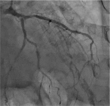 Target lesion : LM bifurcation (111)