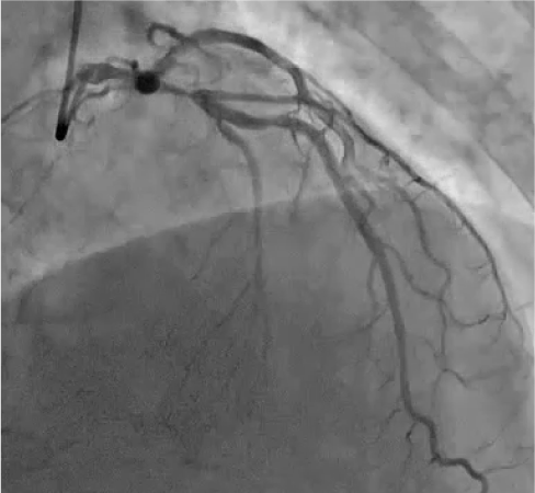 Target lesion : LM bifurcation (111)