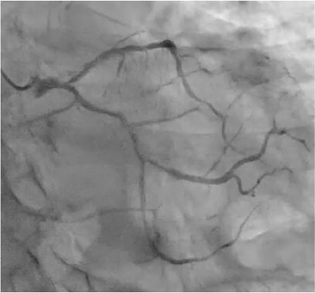 Target lesion : LM bifurcation (111)