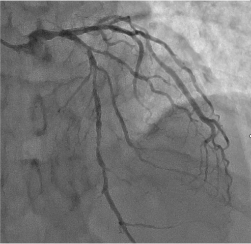 Target lesion : LM bifurcation (111)